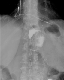 Röntgenbild Breischluck 2 Tage nach endoskopischen Eingriff