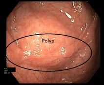 Colon mit Polyp intramuskulär.