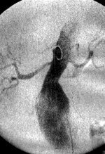 Aortenaneurysma, intraoperativ vor Stentgraftimplantation