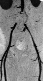 Infrarenaler Aortenverschluss und Beckenverschluss beidseits MR-Angiografie