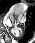 Einengung der Aortenklappe